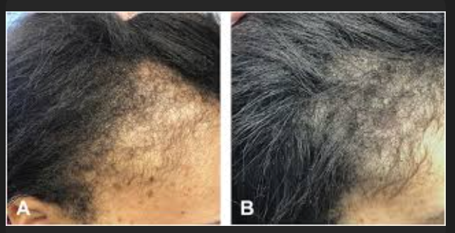 Minoxidil Solution High Strength
