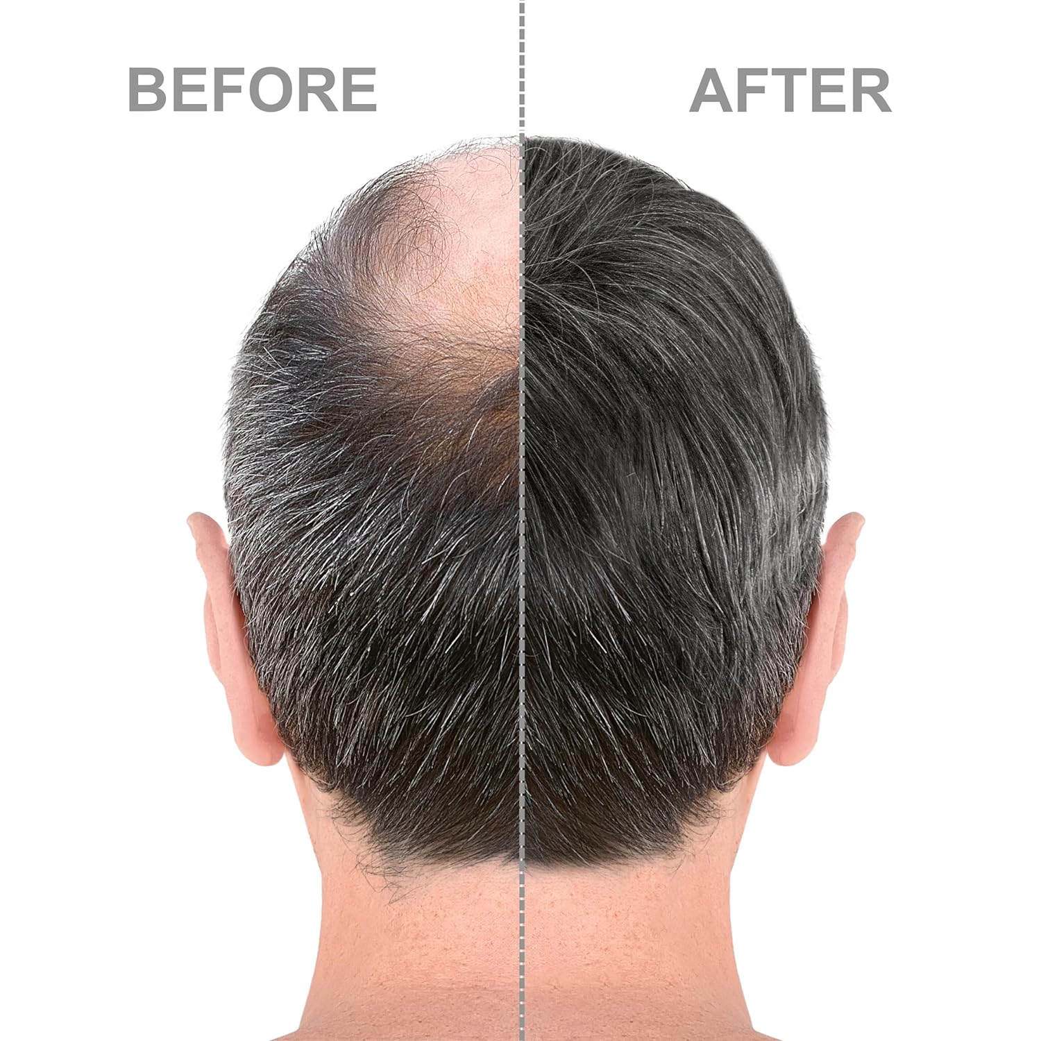 Minoxidil Hair Growth Treatment™