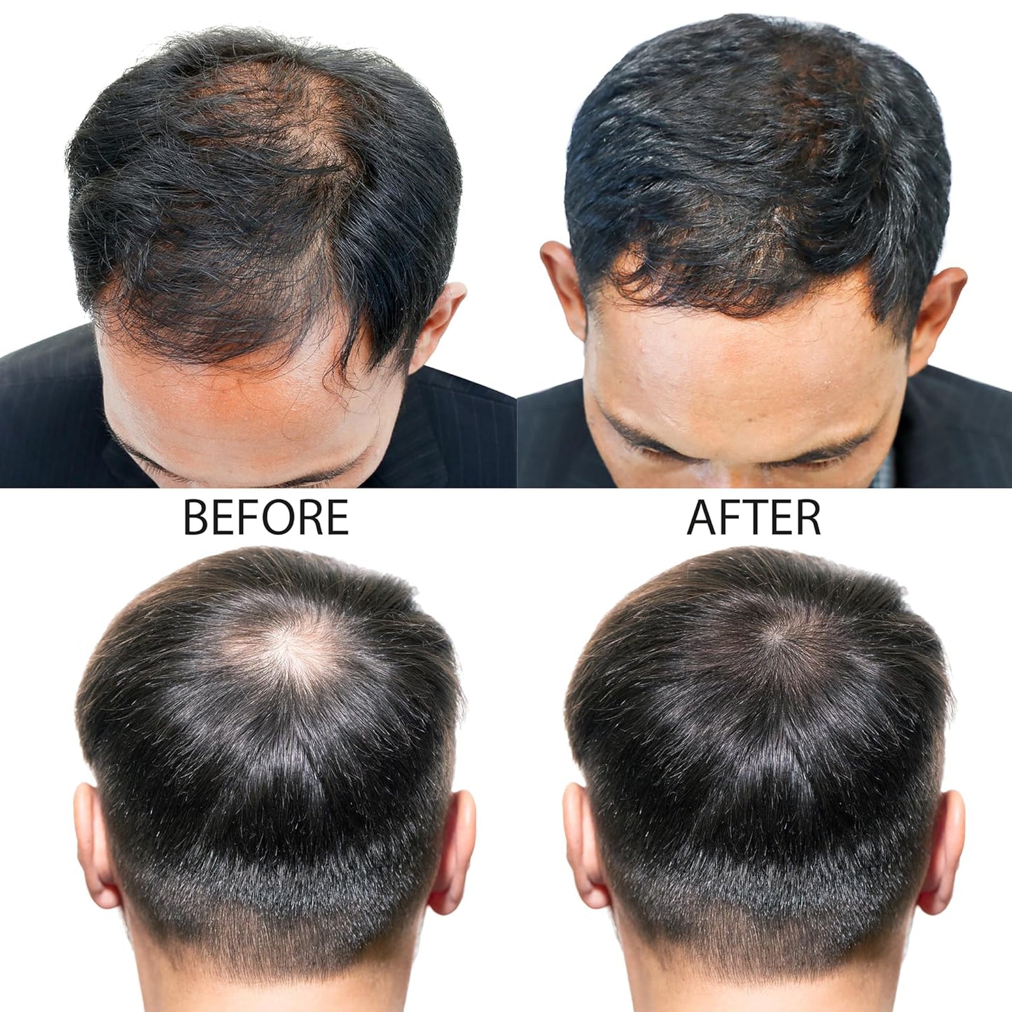 Minoxidil Hair Growth Treatment™