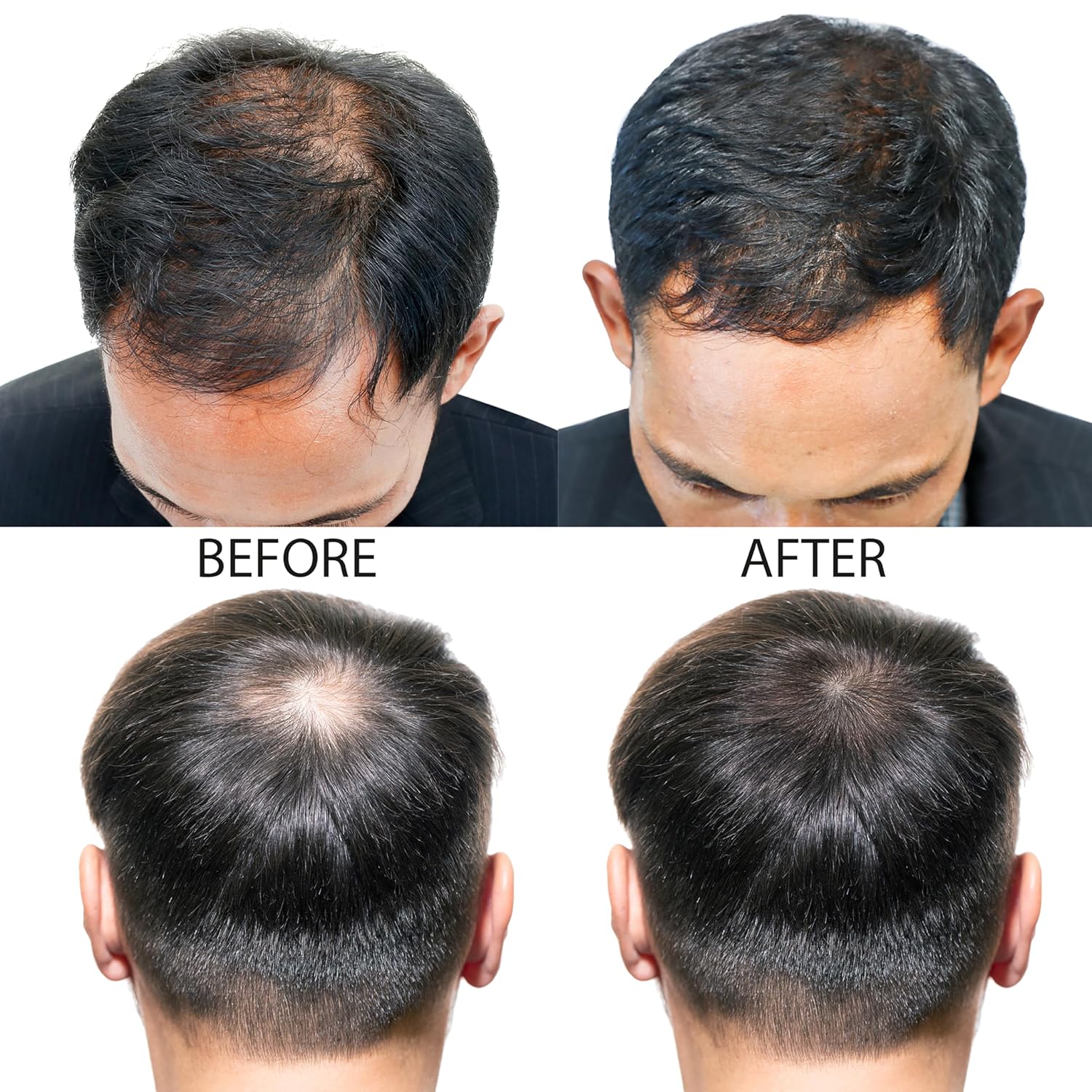 Minoxidil Hair Growth Treatment™