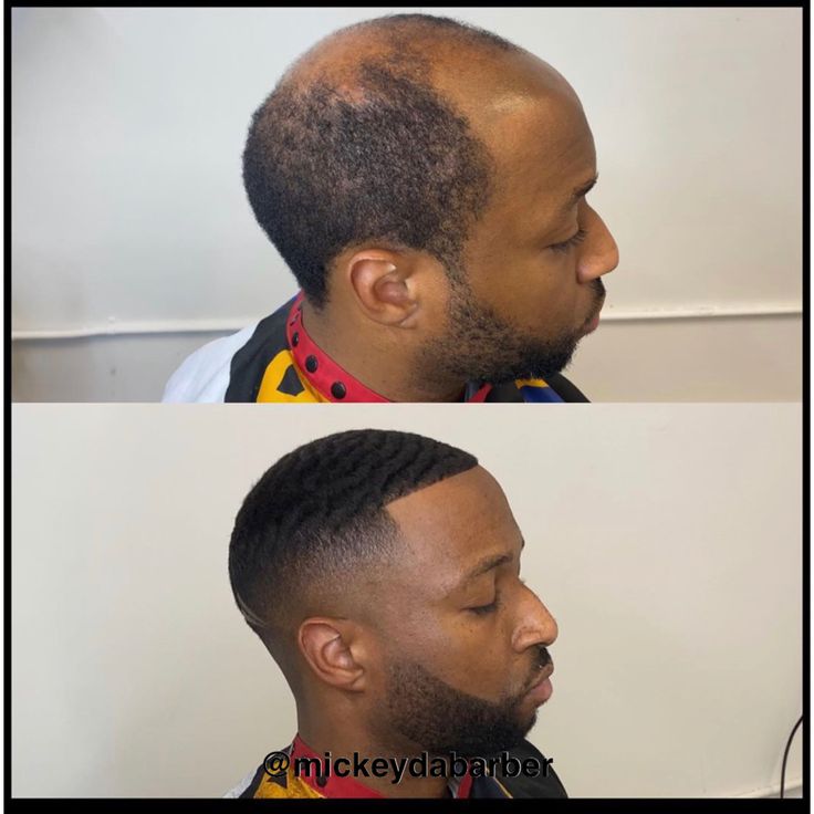 Minoxidil Solution High Strength