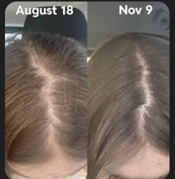 Minoxidil Solution High Strength