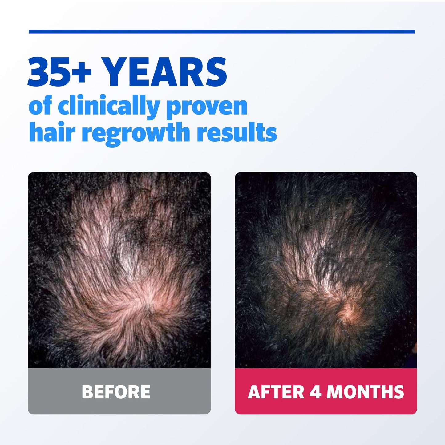 Minoxidil Solution High Strength